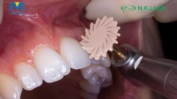 Đánh bóng răng trong phòng LAB là quy trình loại bỏ phần vật liệu dư thừa; mài nhẵn