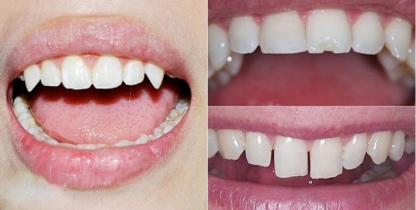 Mũi mài được sử dụng cho trường hợp răng mẻ và bị dài quá mức