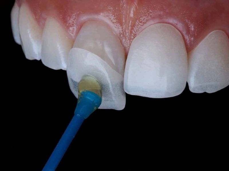 Tìm hiểu về keo dán răng nha khoa