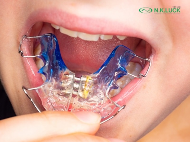 Khí cụ nong hàm giúp mở rộng khung xương hàm