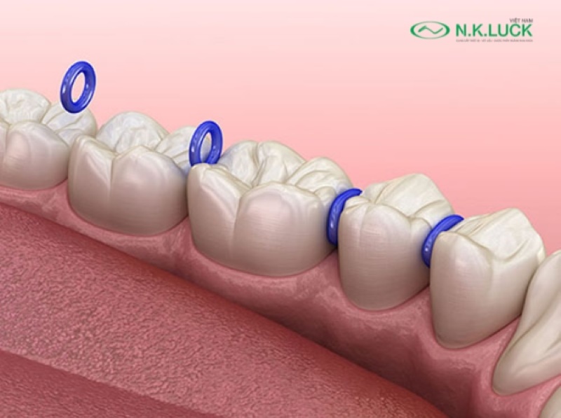 Chun tách kẽ được sử dụng trong quá trình niềng răng