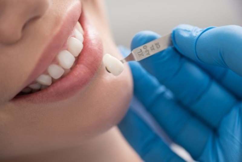 Nghiên cứu các yếu tố ảnh hưởng đến phương pháp bọc răng sứ không mài