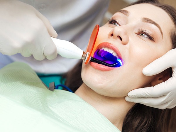 Những trường hợp phổ biến cần sử dụng đèn trám răng
