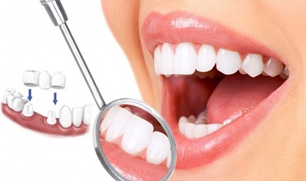 Tự tin hơn với làm răng tạm trong thời gian chờ đợi