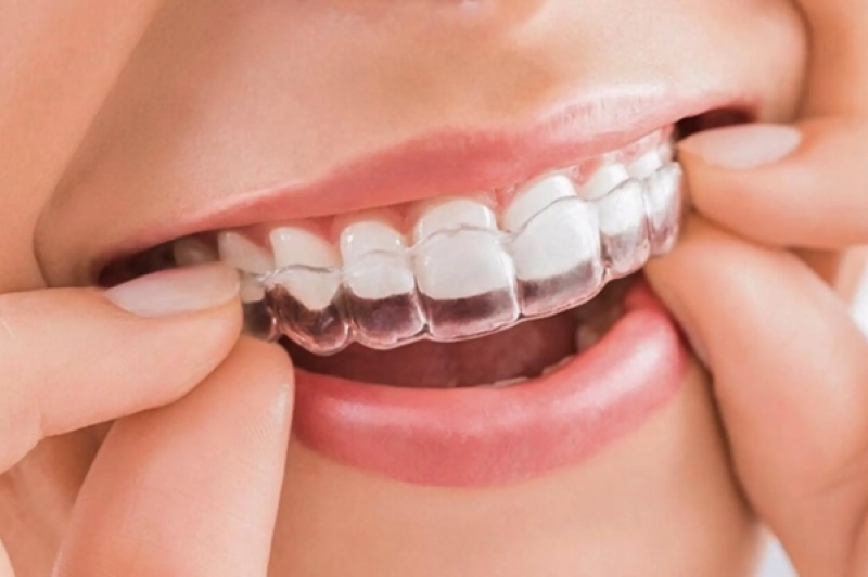 Công dụng khi sử dụng hàm chống nghiến răng
