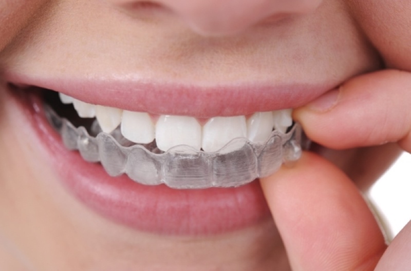Niềng răng 3D Clear nguyên lý hoạt động tương tự như Invisalign