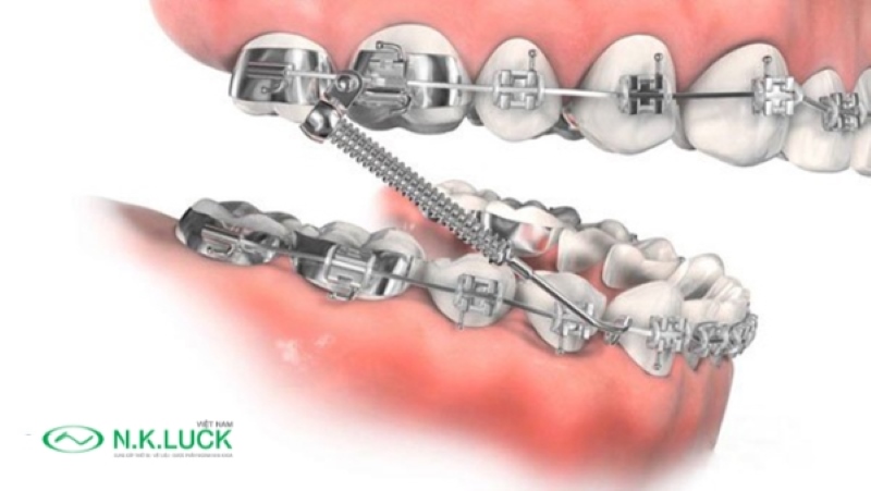 lò xo được sử dụng với mục đích tạo và duy trì khoảng trống giữa các răng