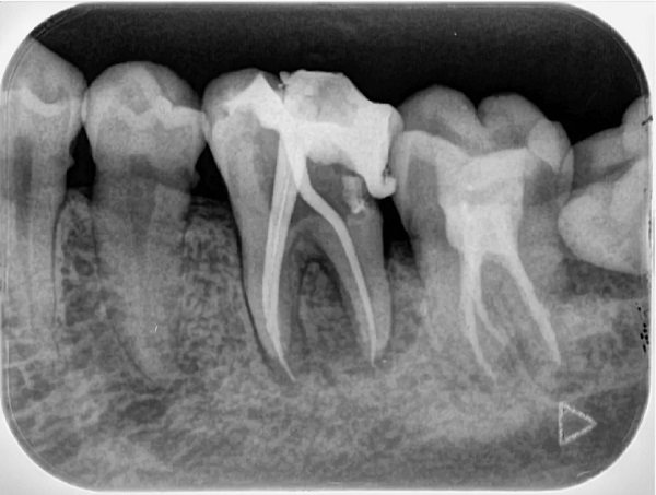 Chụp X quang 01 răng giúp xác định tổn thương ở răng