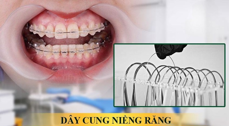 Dây cung được xem là khí cụ không thể thiếu trong niềng răng