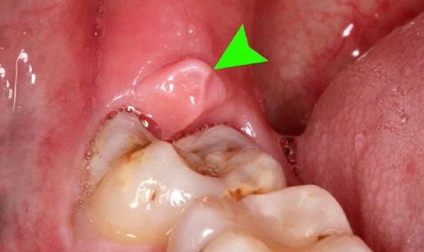 Nướu răng bị sưng gây ảnh hưởng đến sức khỏe răng miệng