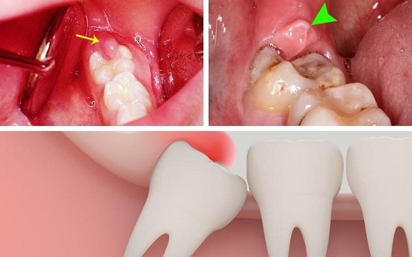 Thăm khám và điều trị sưng nướu