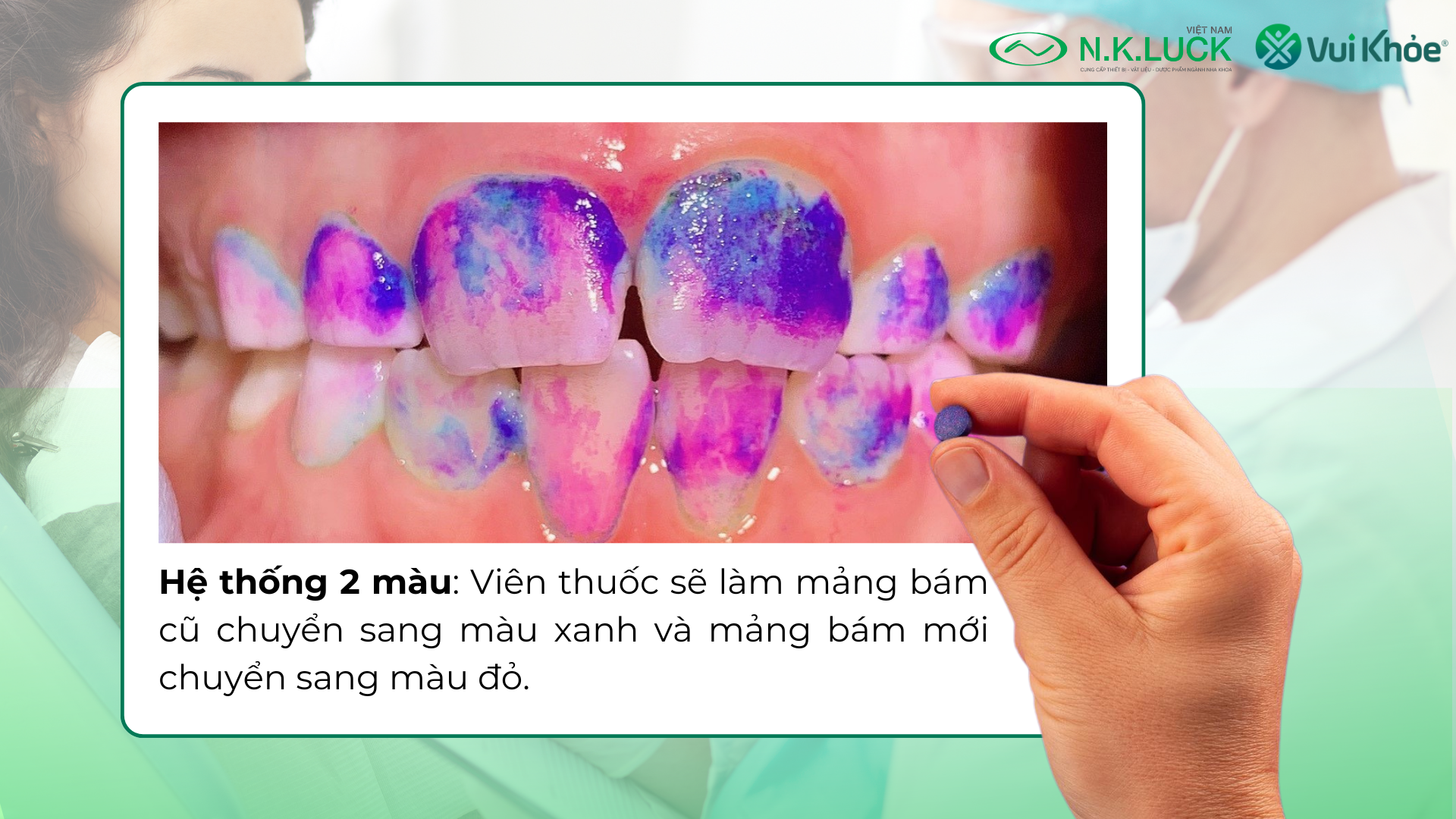 Viên Nhai Chỉ Thị Mảng Bám