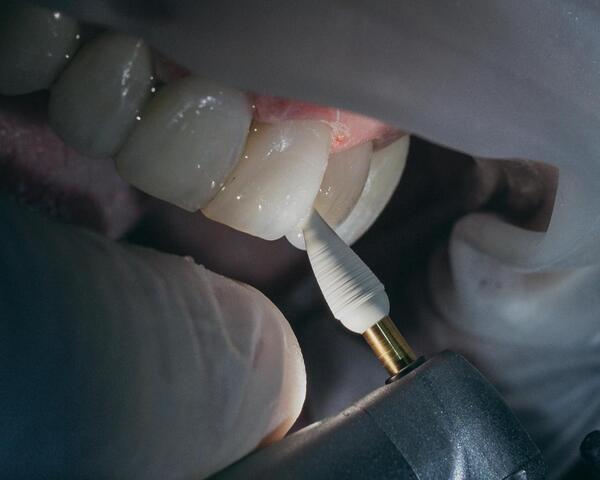 Đánh bóng bề mặt chân răng lộ ra trong quá trình phẫu thuật để giảm nội độc tố và hệ vi sinh trên phần Cementum