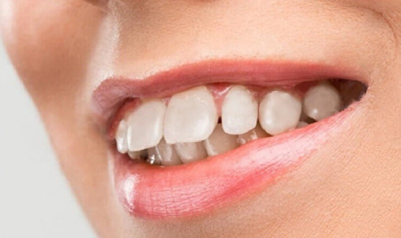 Răng hô, vẩu khiến gương mặt mất đi nét hài hòa Răng hô, vẩu khiến gương mặt mất đi nét hài hòa