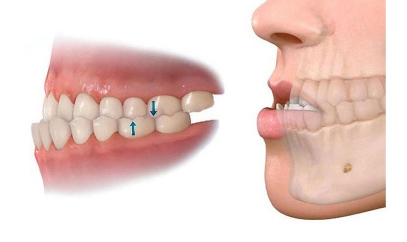 Răng móm ảnh hưởng đến chức năng nhai Răng móm ảnh hưởng đến chức năng nhai