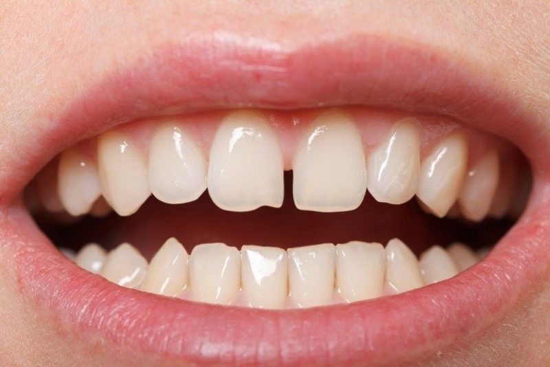 Răng thưa khiến vi khuẩn, mảng bám dễ dàng tích tụ Răng thưa khiến vi khuẩn, mảng bám dễ dàng tích tụ
