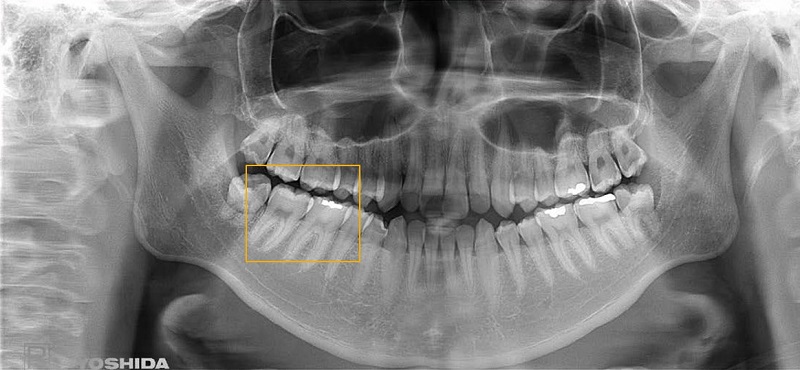 Chụp X-Quang toàn cảnh hàm răng