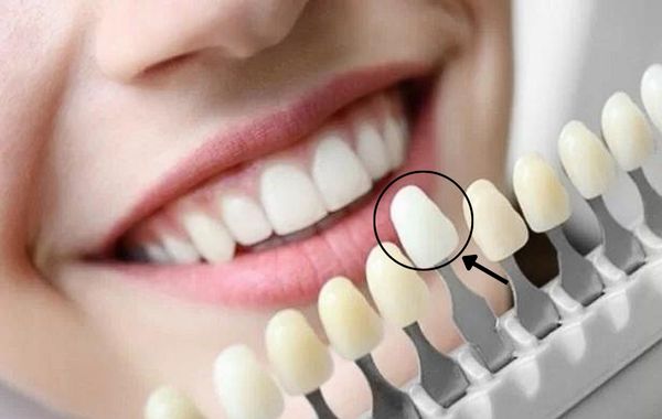 Chọn răng sứ theo màu răng thật là một trong những cách chọn màu răng sứ thẩm mỹ