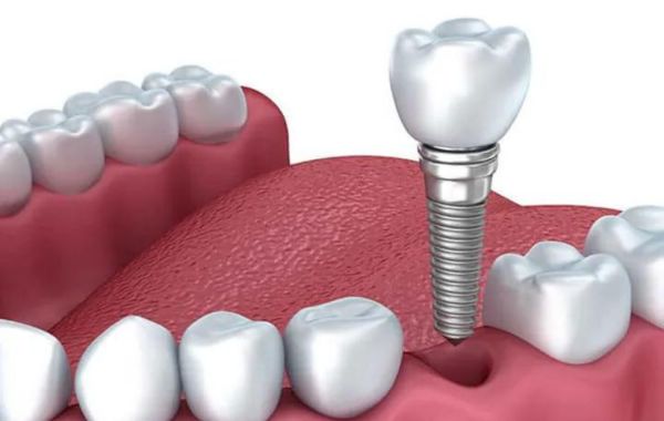 Phục hình răng implant bằng vật liệu phục hình CAD CAM VITA
