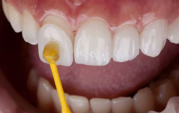 Phương pháp phục hình răng veneer bằng vật liệu phục hình CAD CAM VITA