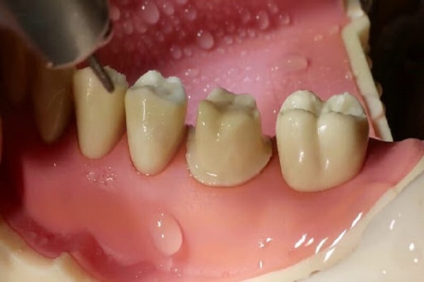 Mài cùi răng là phương pháp trong thẩm mỹ nha khoa