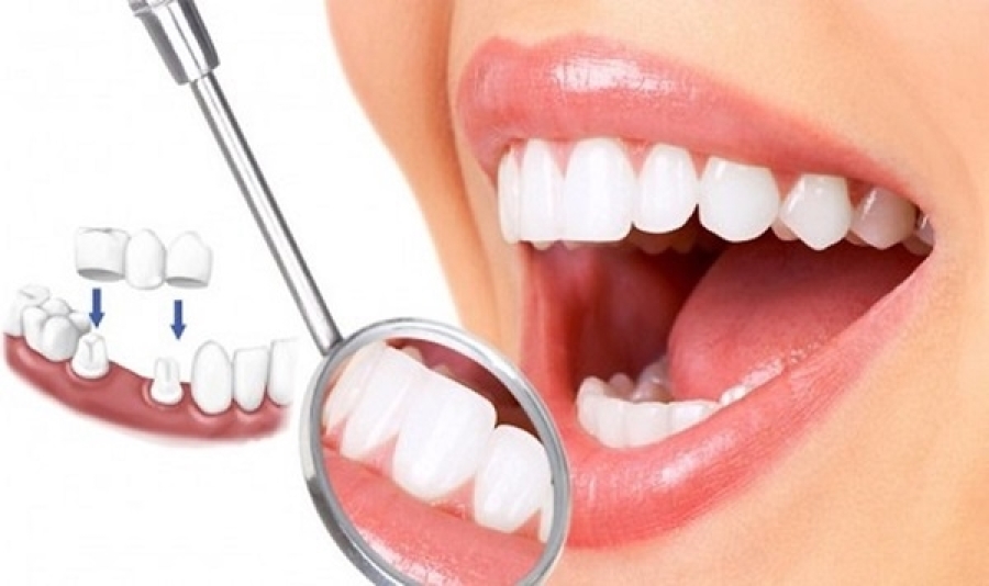Tự tin hơn với làm răng tạm trong thời gian chờ đợi