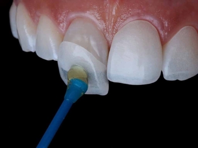 Giới thiệu về keo dán răng nha khoa
