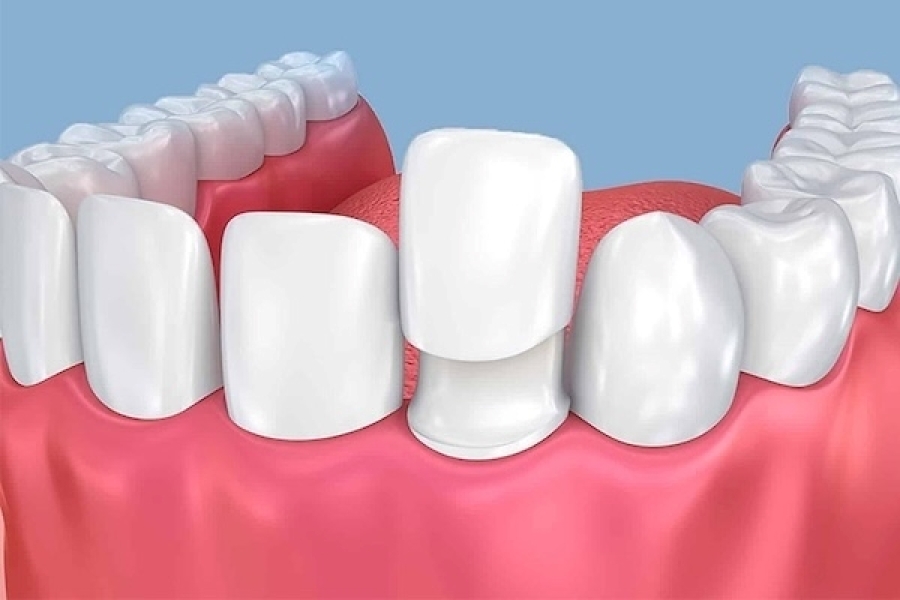 Gắn răng tạm sau khi mài răng​