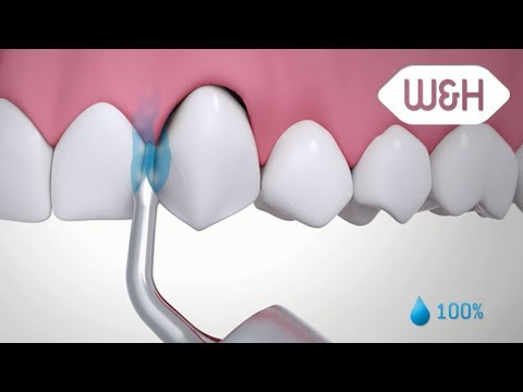 W&H Piezomed – tooth extraction