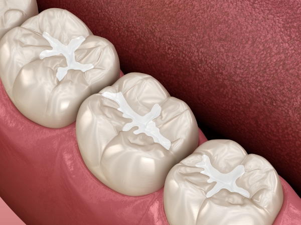 Trám răng là phương pháp sử dụng Composite để phục hồi các răng sâu