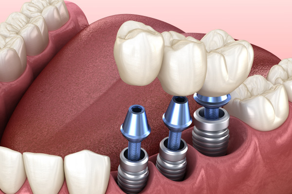 Máy cắm Implant hỗ trợ khoan xương và đặt trụ titan chính xác
