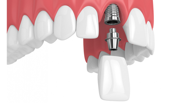 Máy cắm Implant giúp kiểm soát lực xoắn khoan xương, lực xoắn và đặt trụ