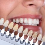 Bảng so màu răng sứ nào tốt nhất?