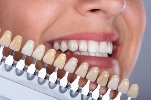 Bảng so màu răng sứ nào tốt nhất?