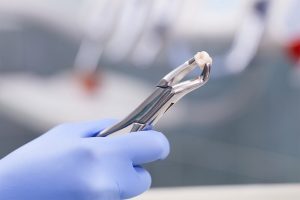 Các loại kìm nhổ răng trong nha khoa phổ biến 