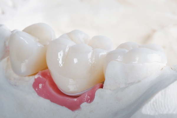 Răng sứ Sagemax không gây đen viền nướu và có tính tương thích sinh học cao
