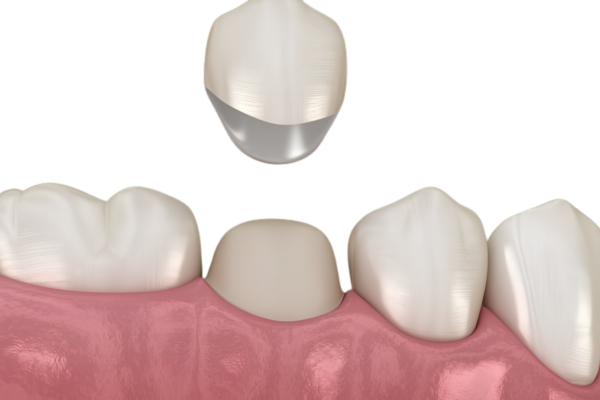 Răng sứ Titan nhẹ và bền hơn răng sứ kim loại thường