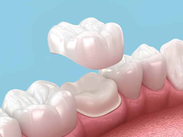 Răng toàn sứ được cấu tạo hoàn toàn từ sứ nguyên khối