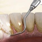 Top 3 máy cạo vôi răng được ưa chuộng hiện nay