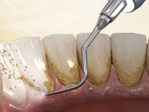 Top 3 máy cạo vôi răng được ưa chuộng hiện nay