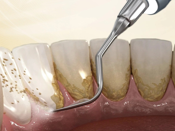 Top 3 máy cạo vôi răng được ưa chuộng hiện nay