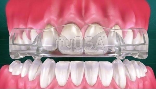 Các phương pháp điều trị nghiến răng khi mẹo dân gian không hiệu quả