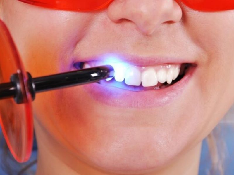 Đèn tẩy trắng răng nha khoa có nhiều công nghệ chiếu sáng hiện đại