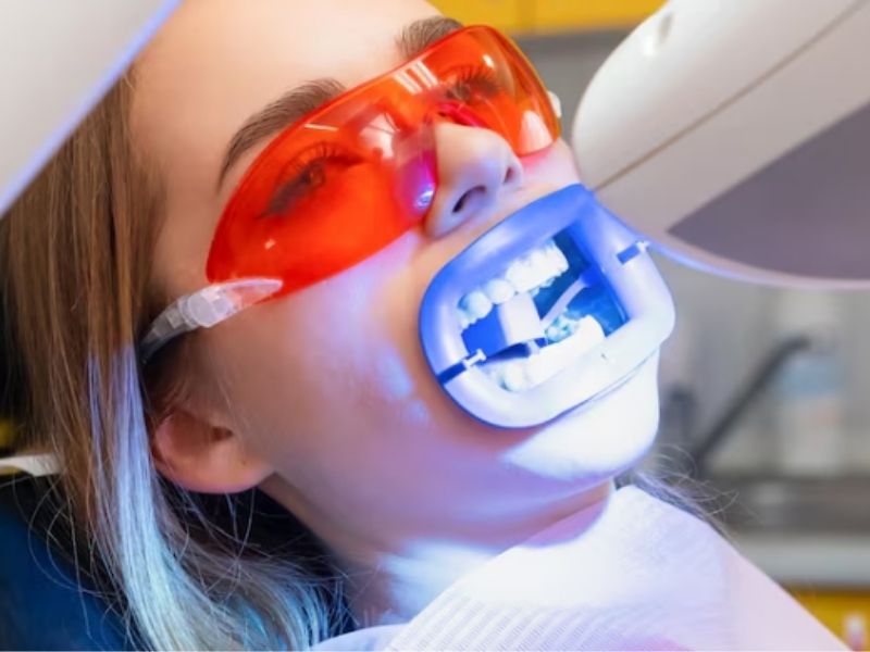 Chuẩn bị trước khi sử dụng đèn tẩy trắng răng