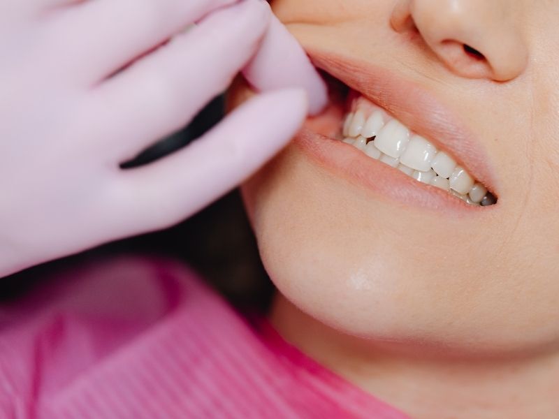 Vô thức nghiến răng ảnh hưởng đến mão, cầu răng và phục hình nha khoa