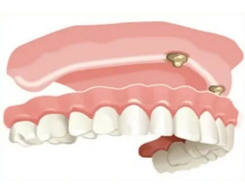 Cấu tạo của hàm giả tháo lắp
