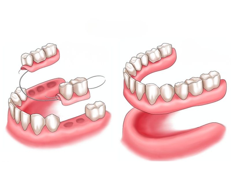 Hàm giả tháo lắp toàn phần và bán phần
