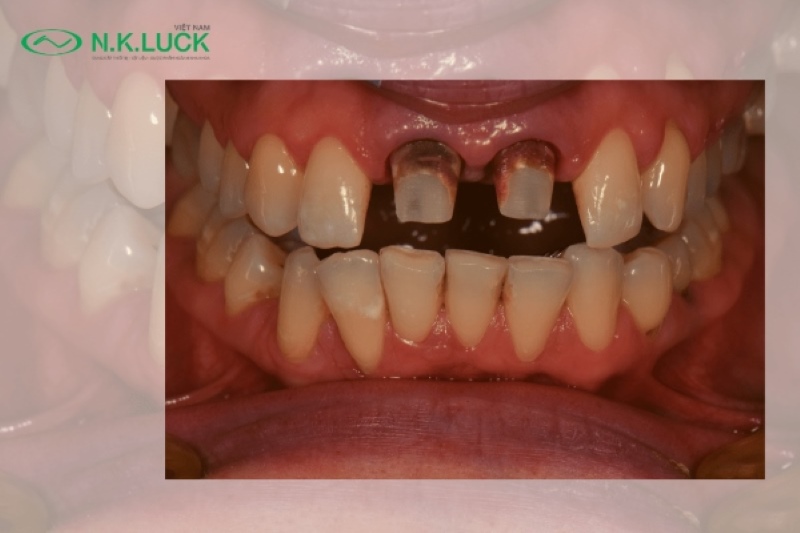 Nhược điểm của việc bọc răng sứ Nhược điểm của việc bọc răng sứ