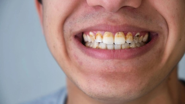 Không lấy cao răng định kỳ có thể dẫn đến nhiều vấn đề về sức khỏe răng miệng