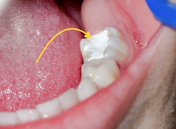 Trám răng tạm thời để làm gì?